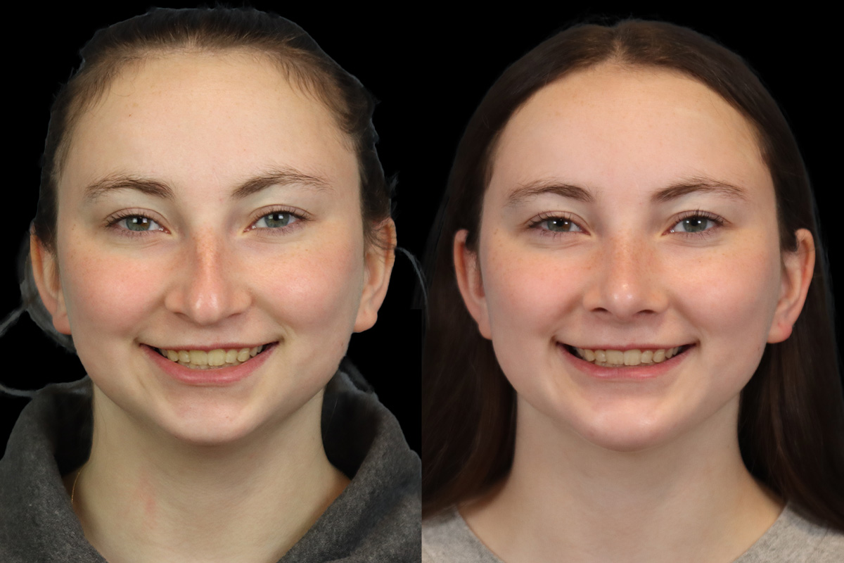 Rhinoplasty Before & After Gallery - Patient 242689 - Image 2