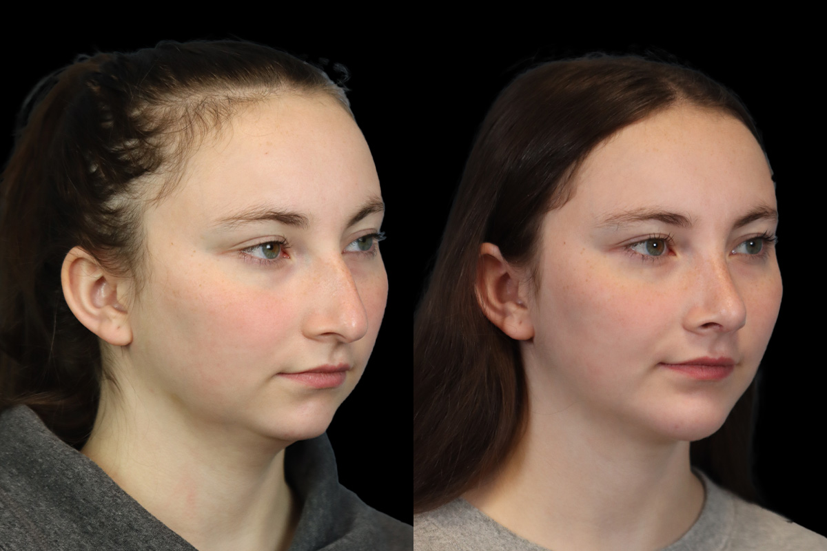 Rhinoplasty Before & After Gallery - Patient 242689 - Image 4