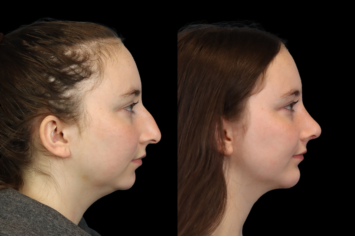 Rhinoplasty Before & After Gallery - Patient 242689 - Image 5