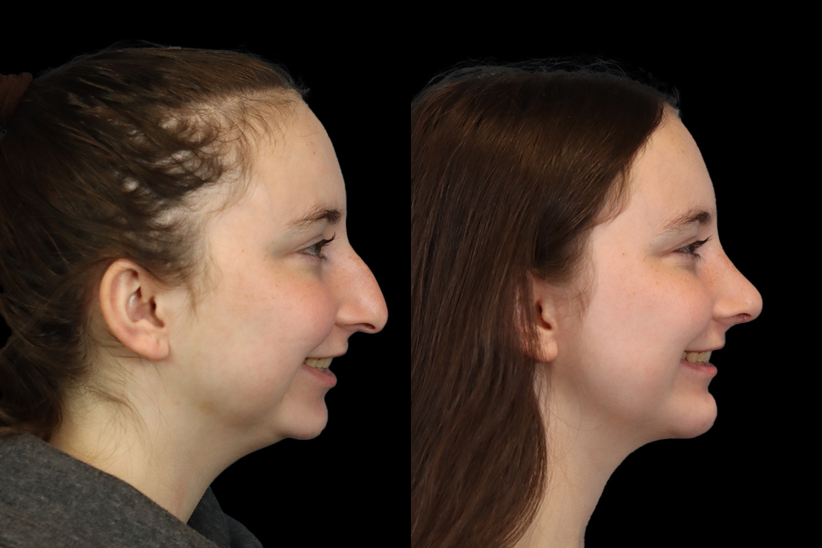 Rhinoplasty Before & After Gallery - Patient 242689 - Image 6