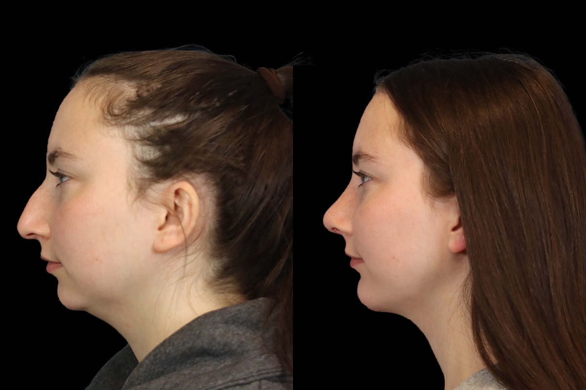 Rhinoplasty Before & After Gallery - Patient 242689 - Image 8