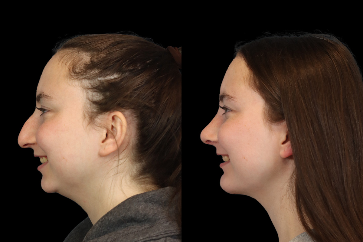 Rhinoplasty Before & After Gallery - Patient 242689 - Image 9