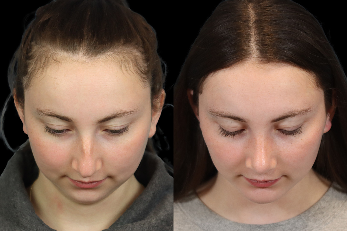 Rhinoplasty Before & After Gallery - Patient 242689 - Image 3