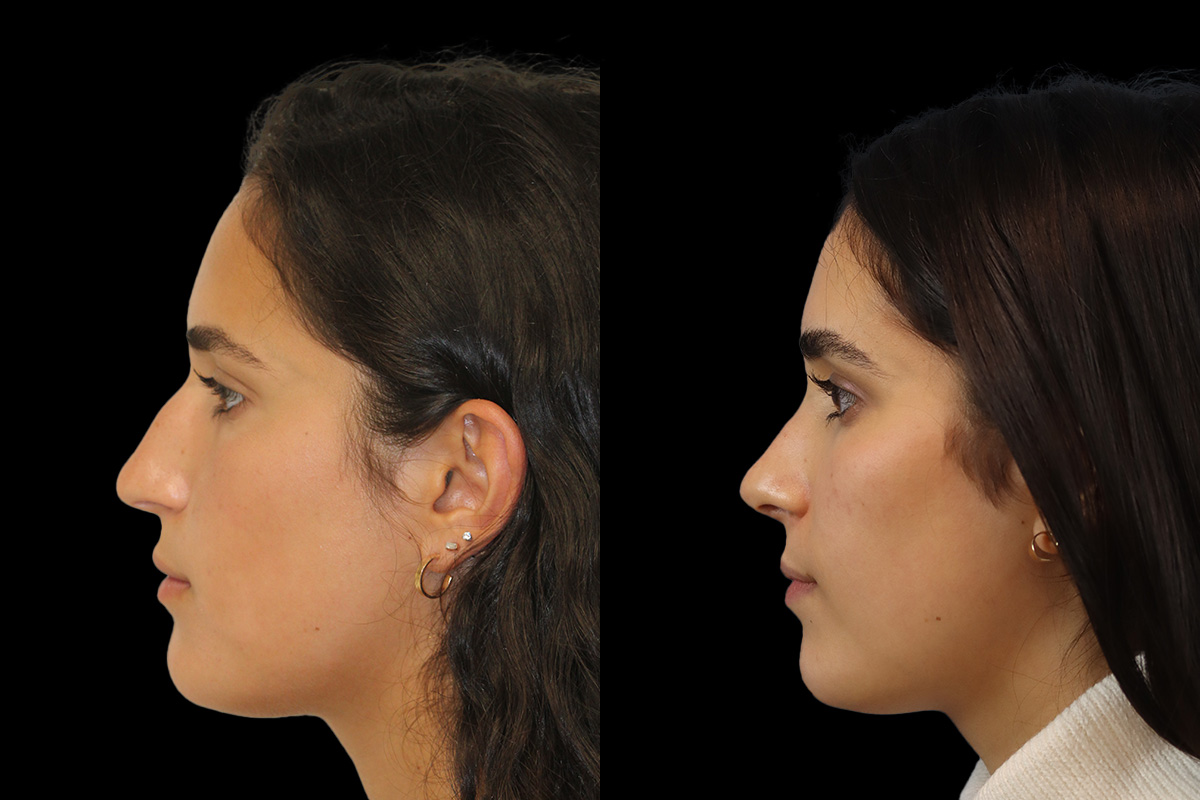 Rhinoplasty Before & After Gallery - Patient 293286 - Image 7