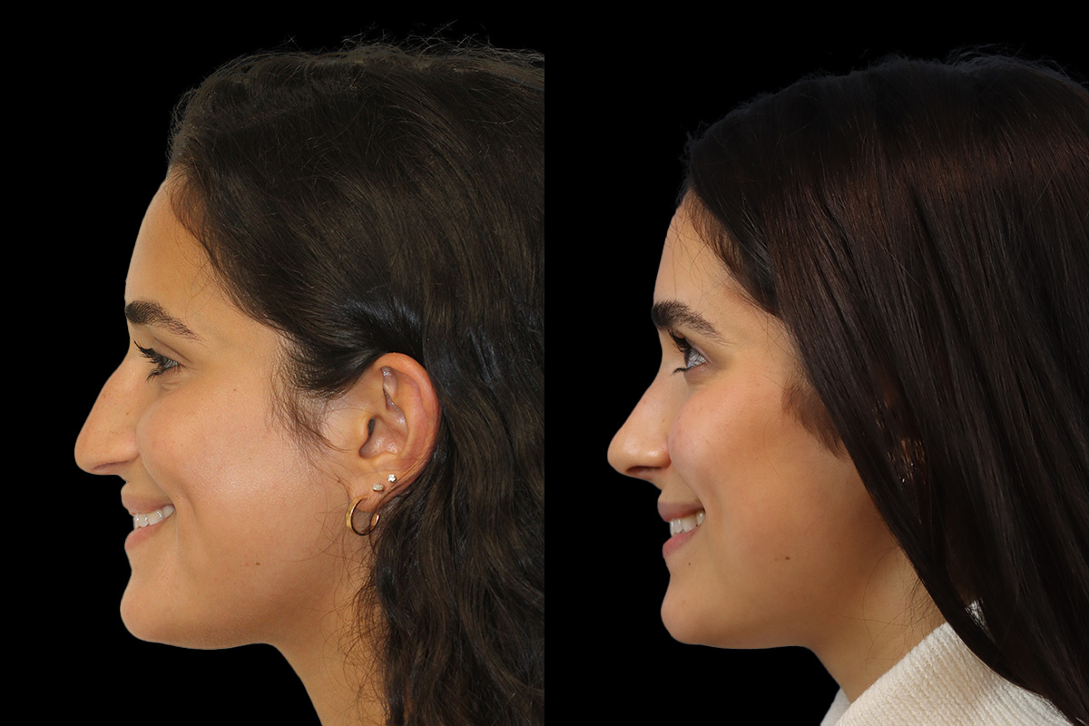 Rhinoplasty Before & After Gallery - Patient 293286 - Image 8