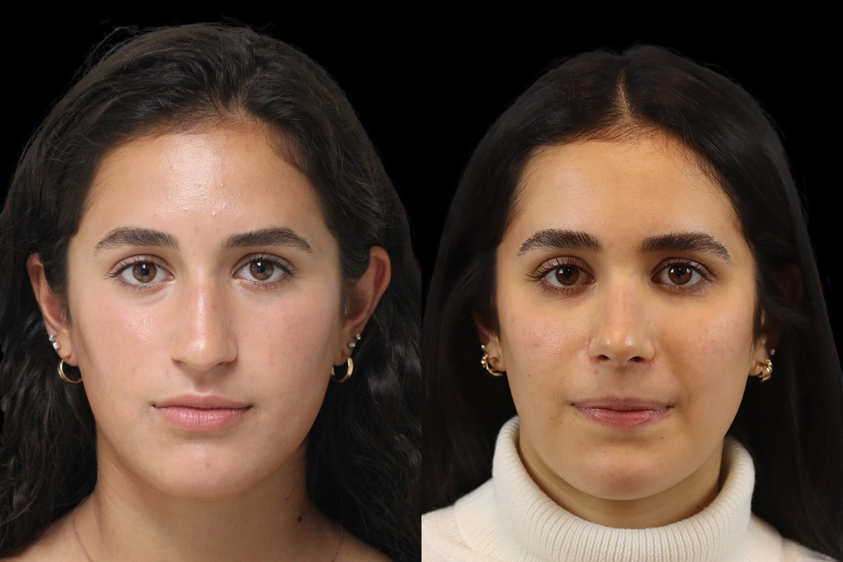 Rhinoplasty Before & After Gallery - Patient 293286 - Image 1