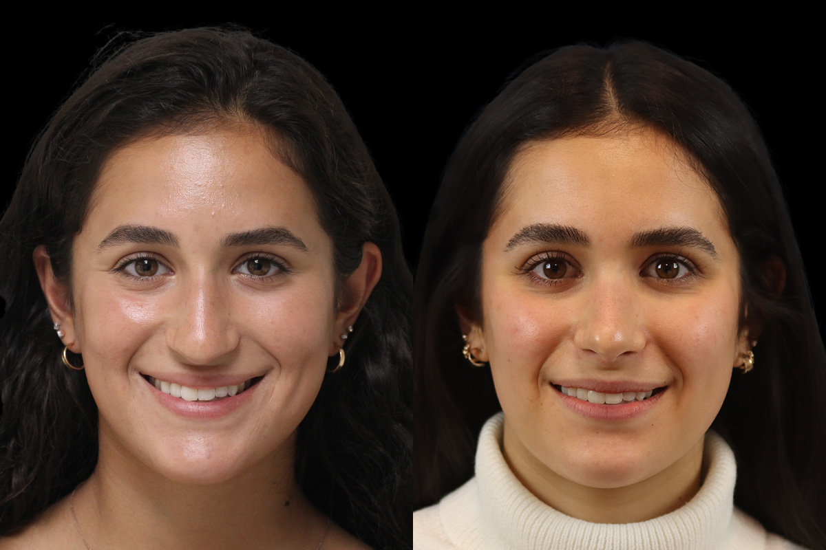 Rhinoplasty Before & After Gallery - Patient 293286 - Image 2