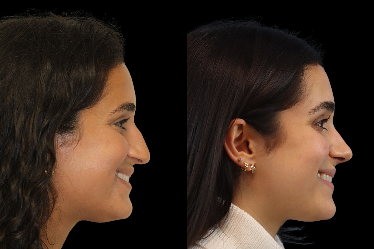 Rhinoplasty Before & After Gallery - Patient 293286 - Image 5