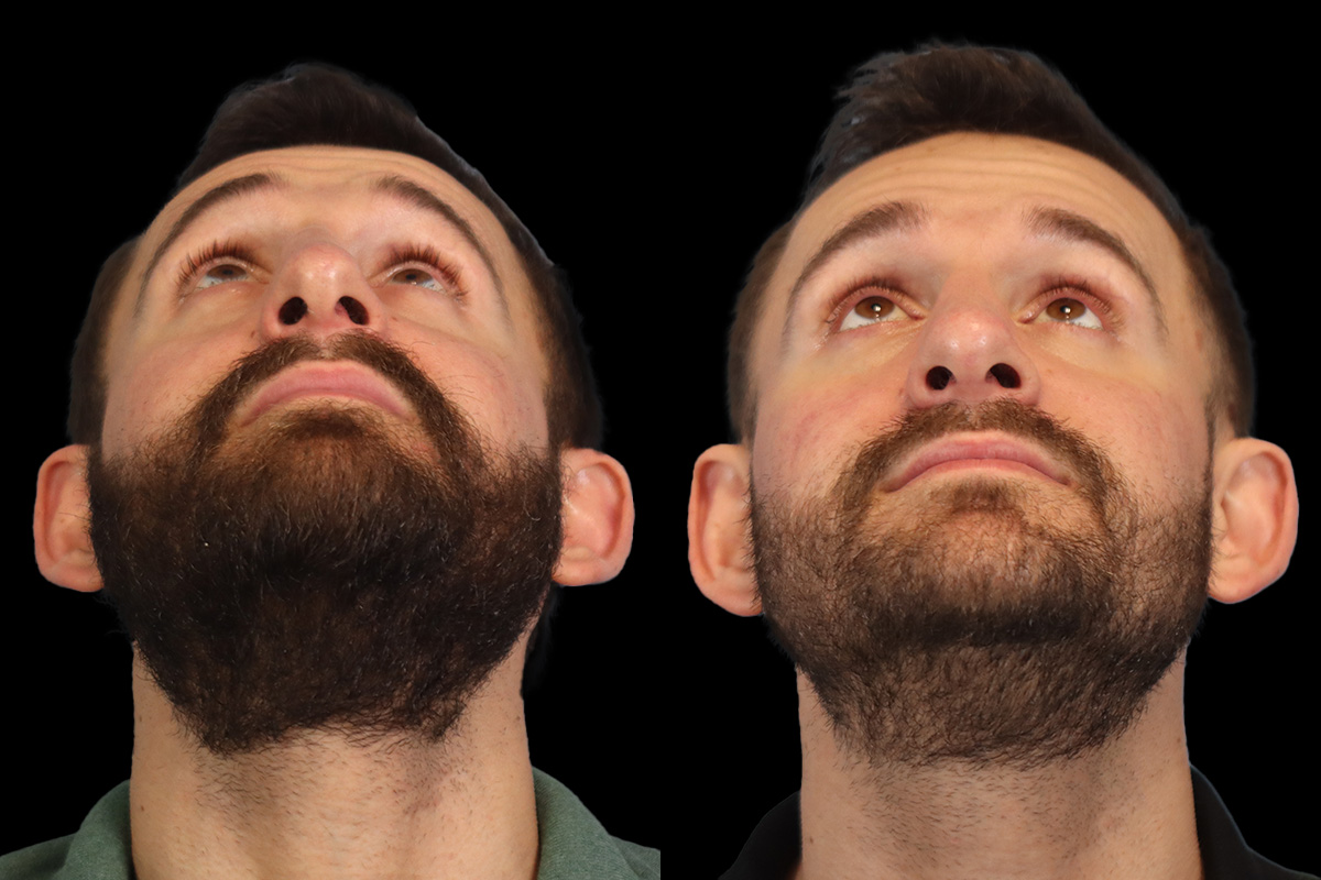 Nose Before & After Gallery - Patient 127945 - Image 11