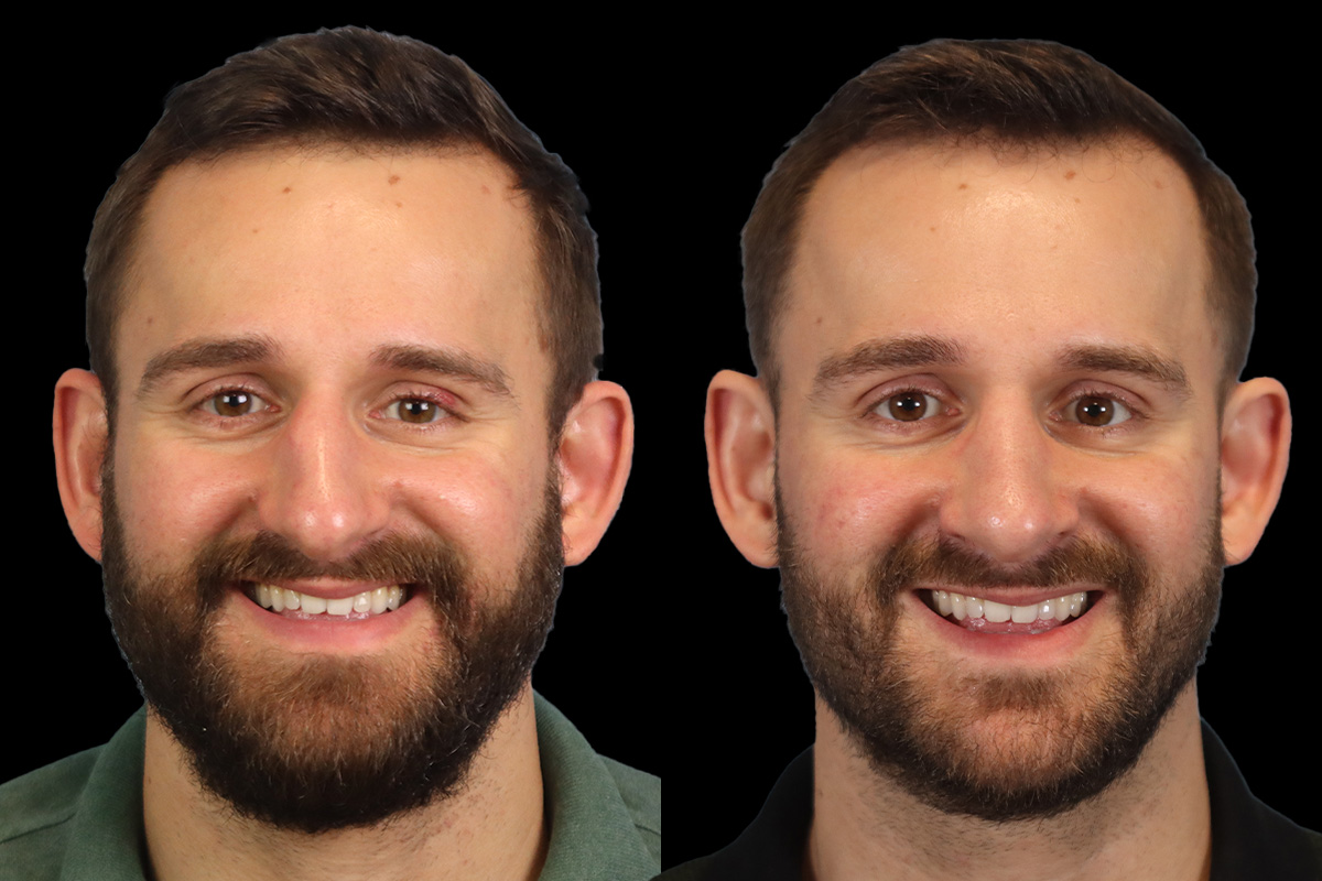 Nose Before & After Gallery - Patient 127945 - Image 2