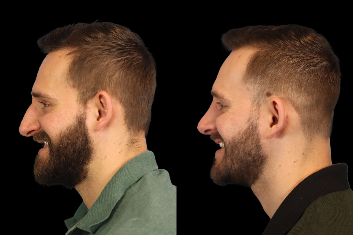 Nose Before & After Gallery - Patient 127945 - Image 10