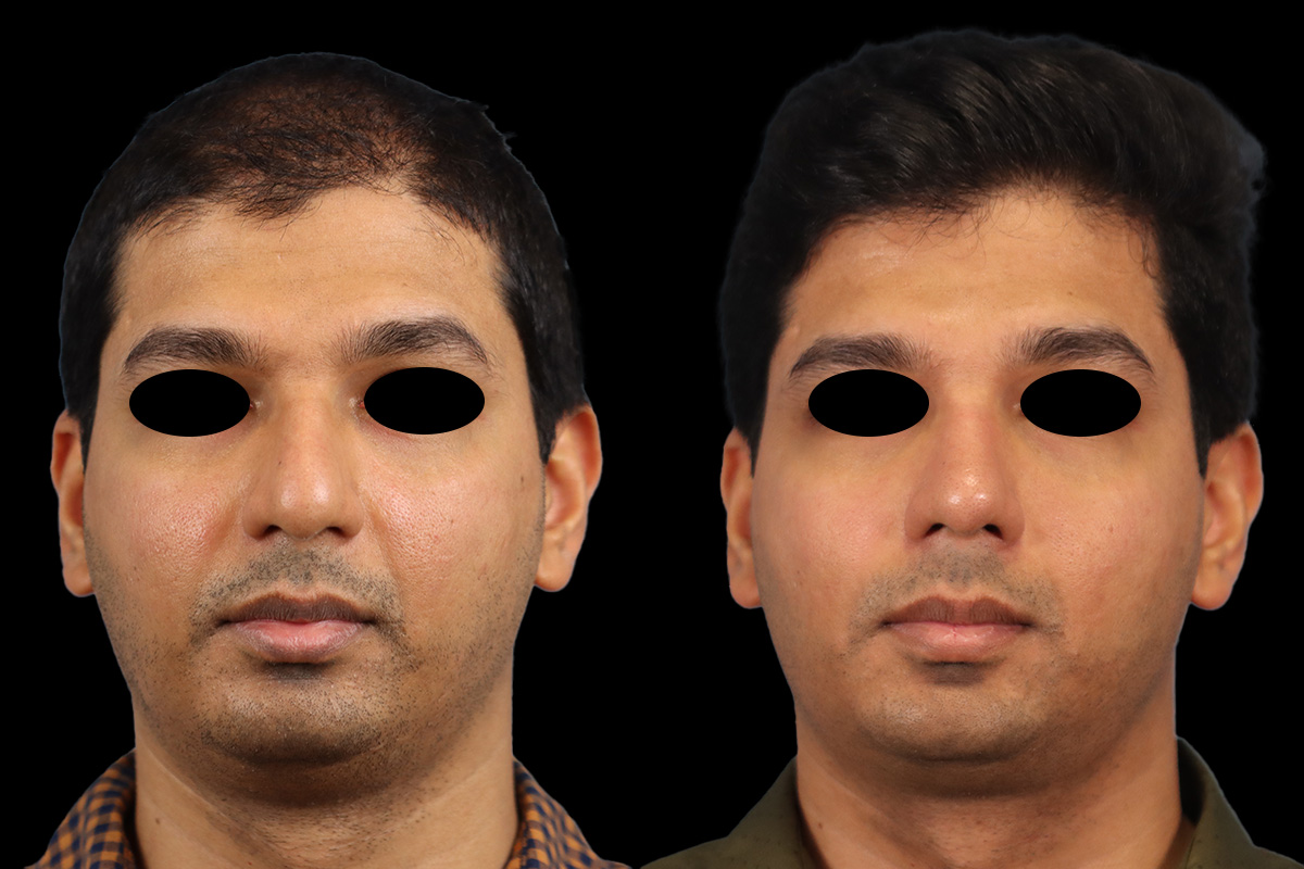 Rhinoplasty Before & After Gallery - Patient 425909 - Image 1
