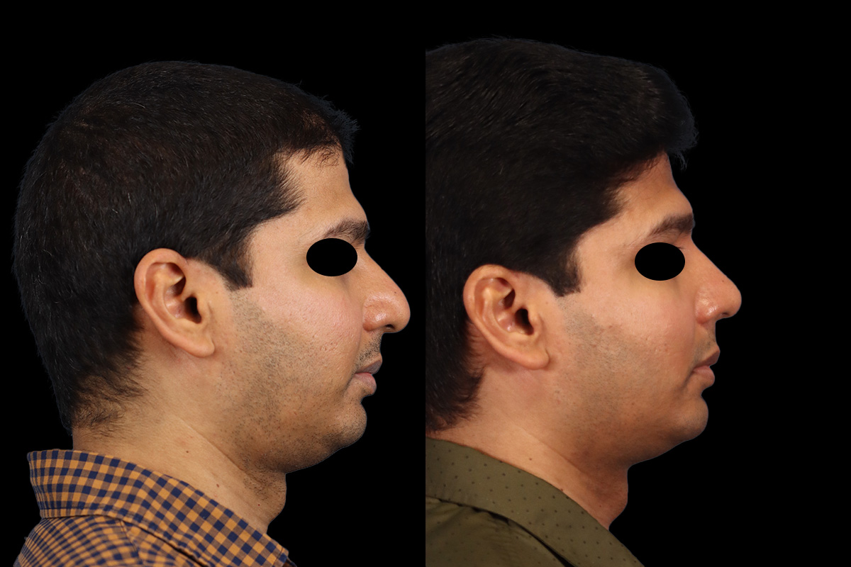 Rhinoplasty Before & After Gallery - Patient 425909 - Image 3
