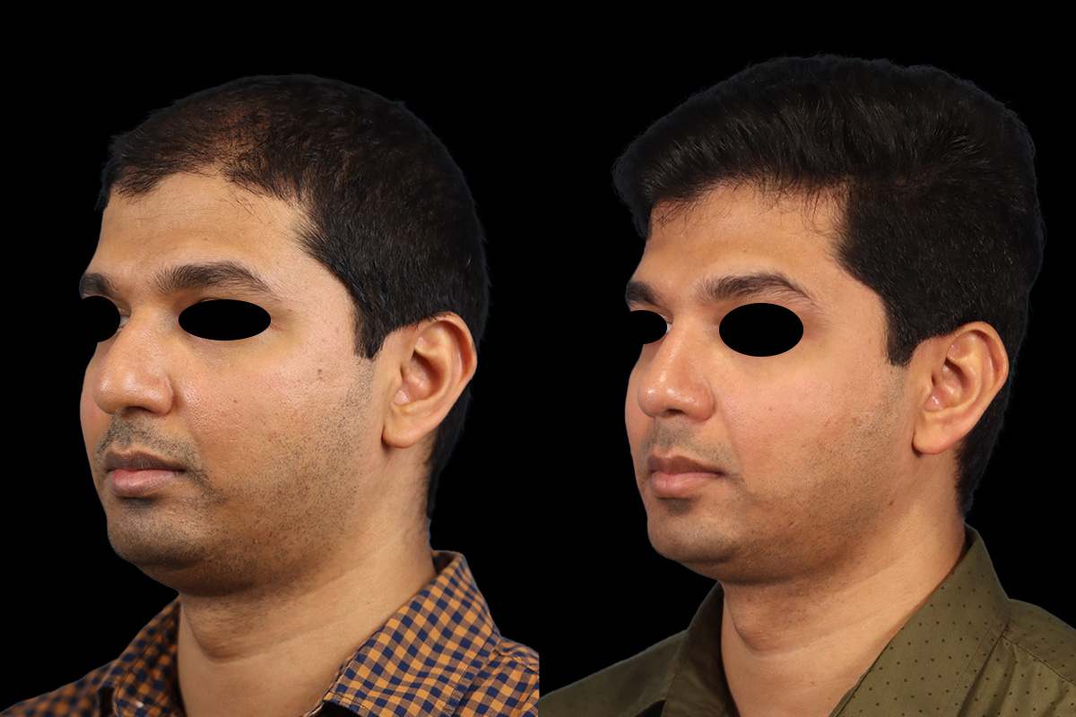Rhinoplasty Before & After Gallery - Patient 425909 - Image 5