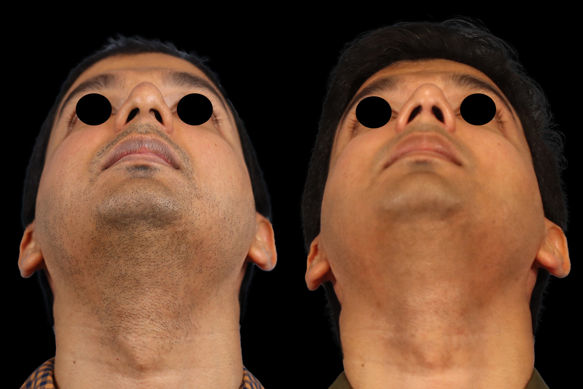 Rhinoplasty Before & After Gallery - Patient 425909 - Image 8