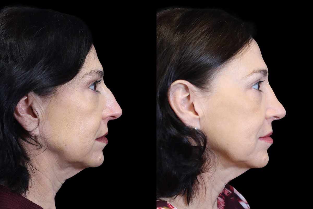Nose Before & After Gallery - Patient 370262 - Image 4