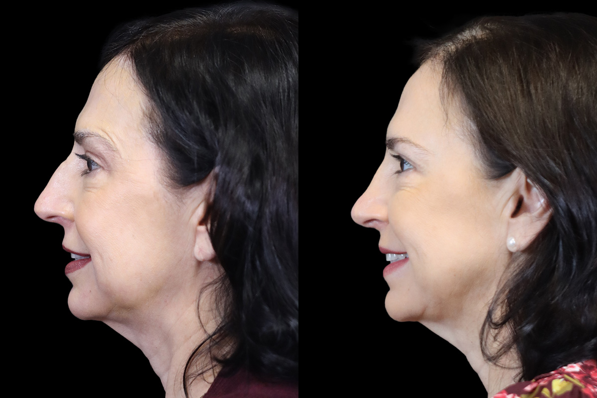 Nose Before & After Gallery - Patient 370262 - Image 8