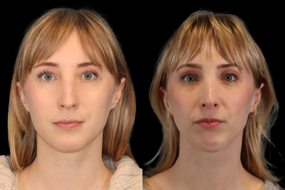 Rhinoplasty Before & After Gallery - Patient 427595 - Image 1