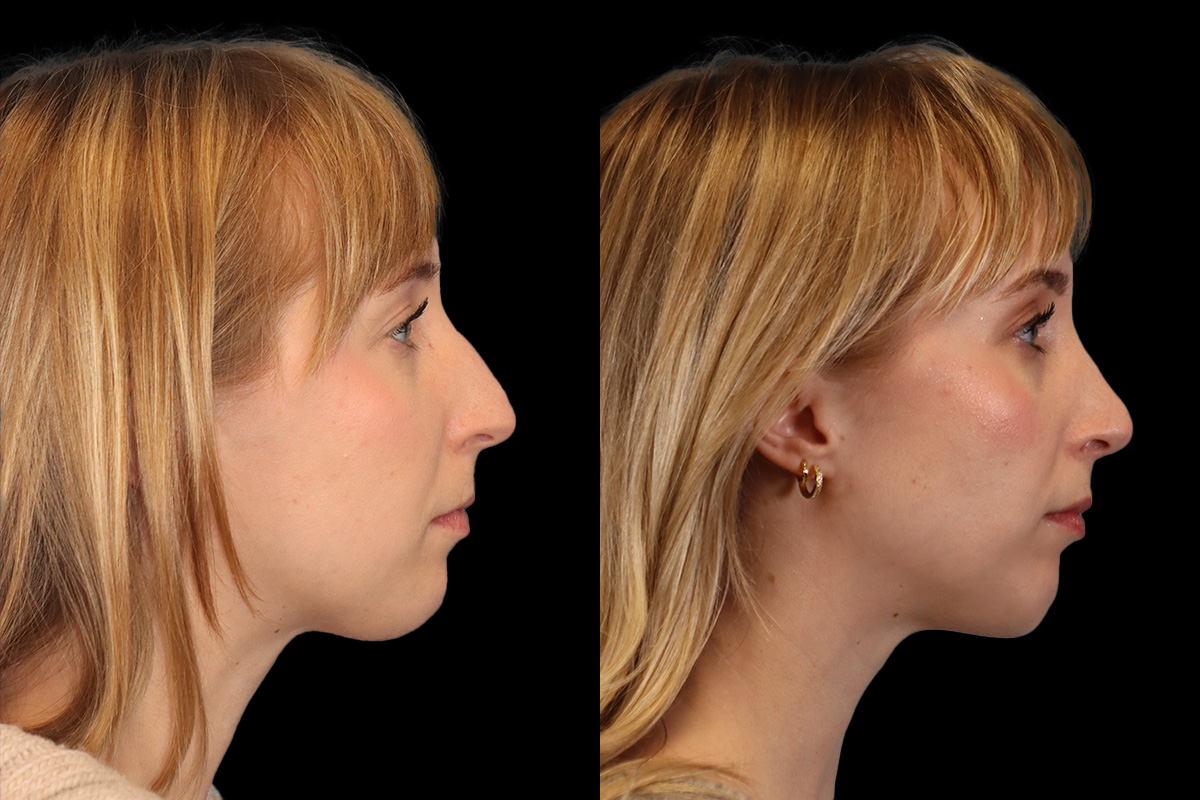 Chin Implant Before & After Gallery - Patient 384265 - Image 1