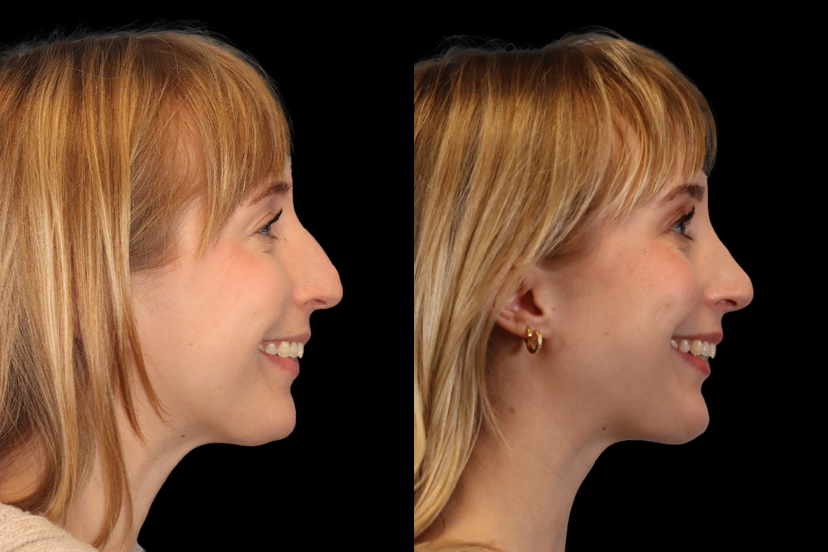 Nose Before & After Gallery - Patient 245038 - Image 5