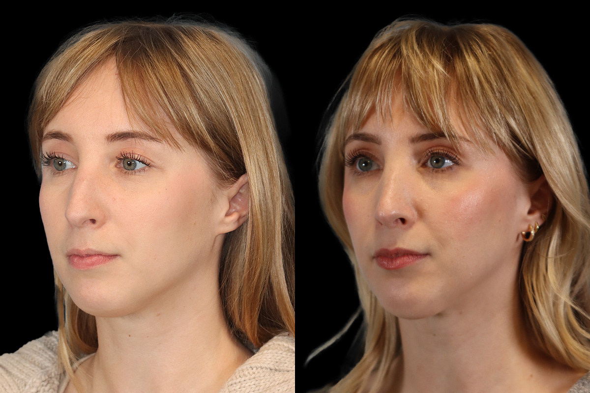 Nose Before & After Gallery - Patient 245038 - Image 6