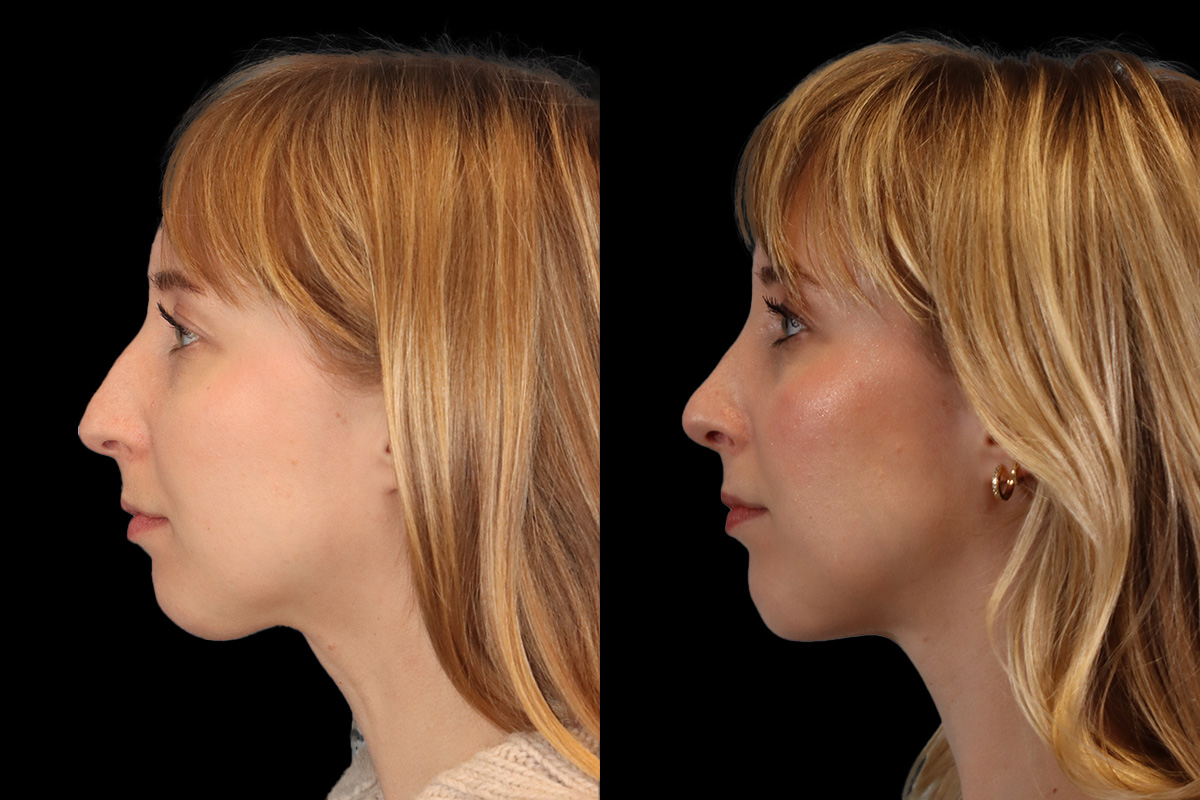 Nose Before & After Gallery - Patient 245038 - Image 7