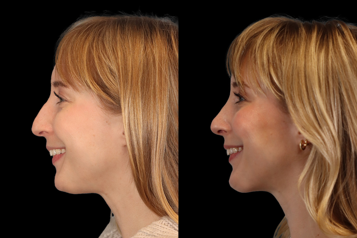 Nose Before & After Gallery - Patient 245038 - Image 8