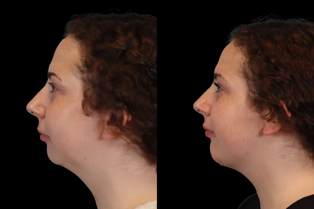 Chin Implant Before & After Gallery - Patient 775633 - Image 7