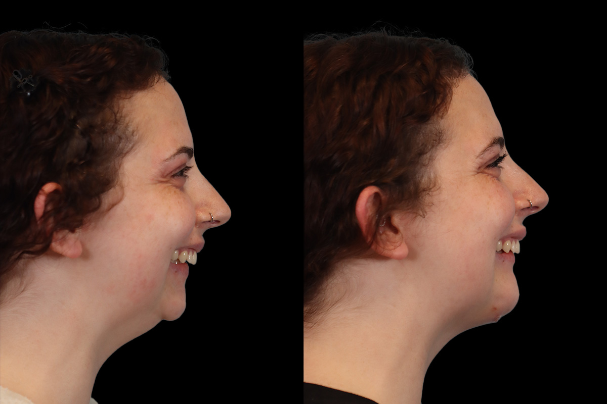 Chin Implant Before & After Gallery - Patient 775633 - Image 2