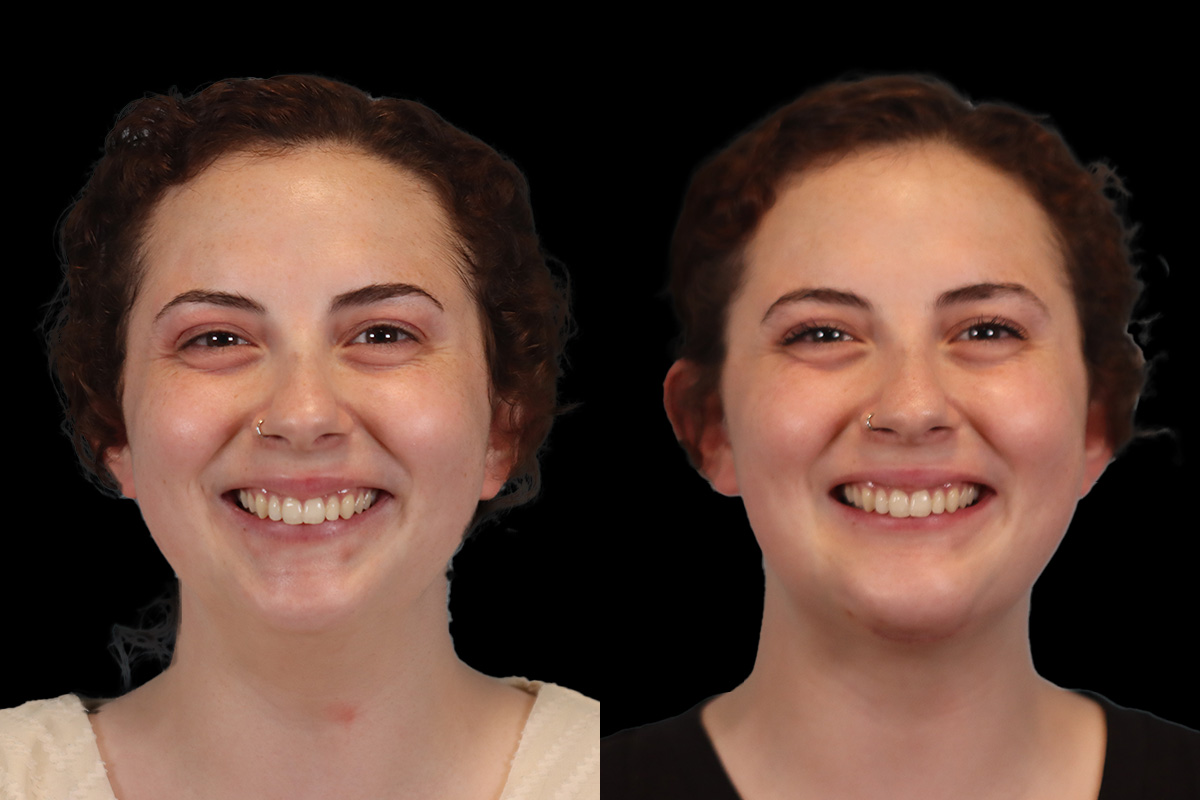 Chin Implant Before & After Gallery - Patient 775633 - Image 5