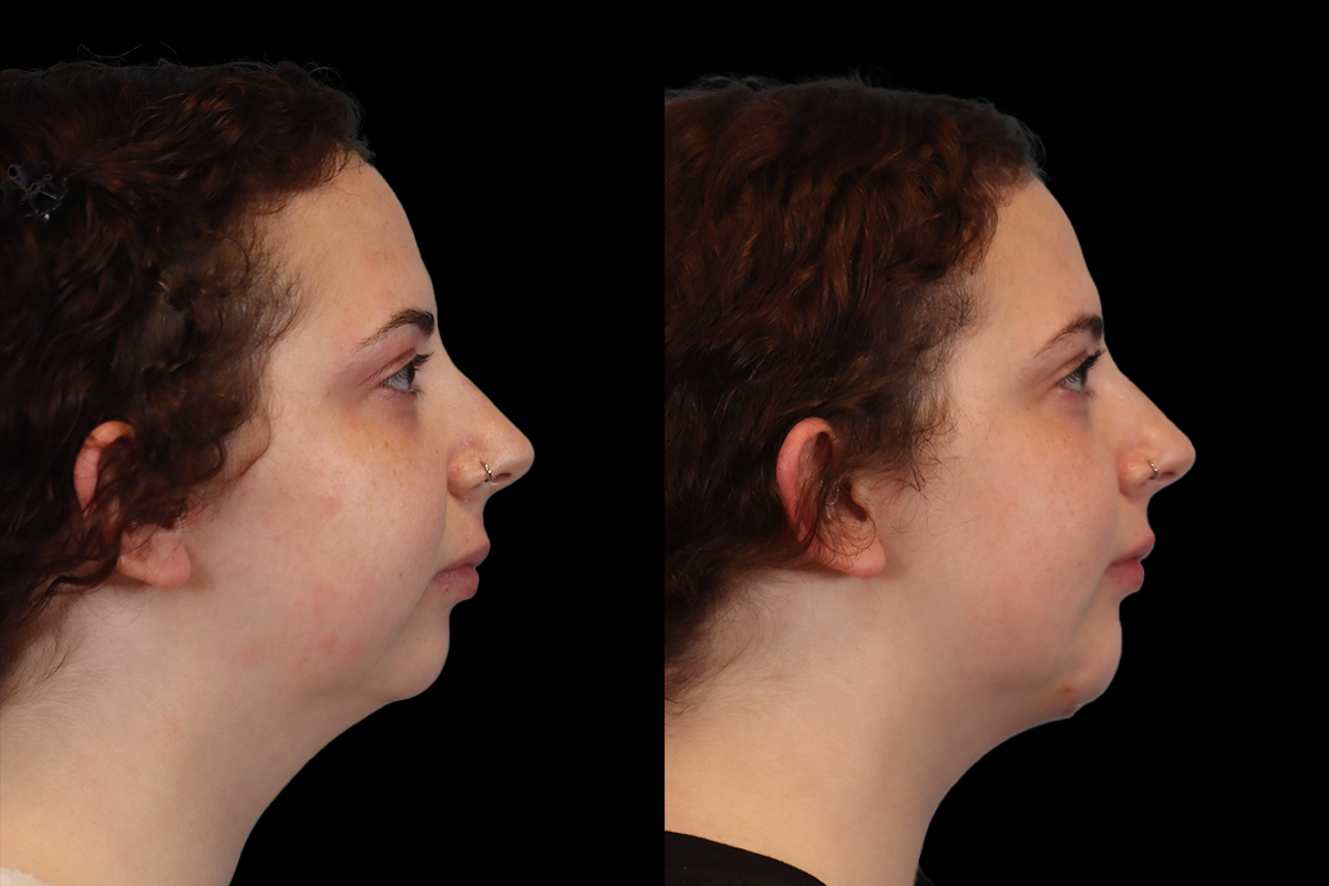 Chin Implant Before & After Gallery - Patient 775633 - Image 1