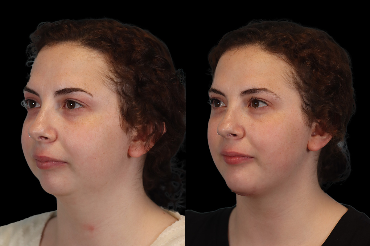 Chin Implant Before & After Gallery - Patient 775633 - Image 6