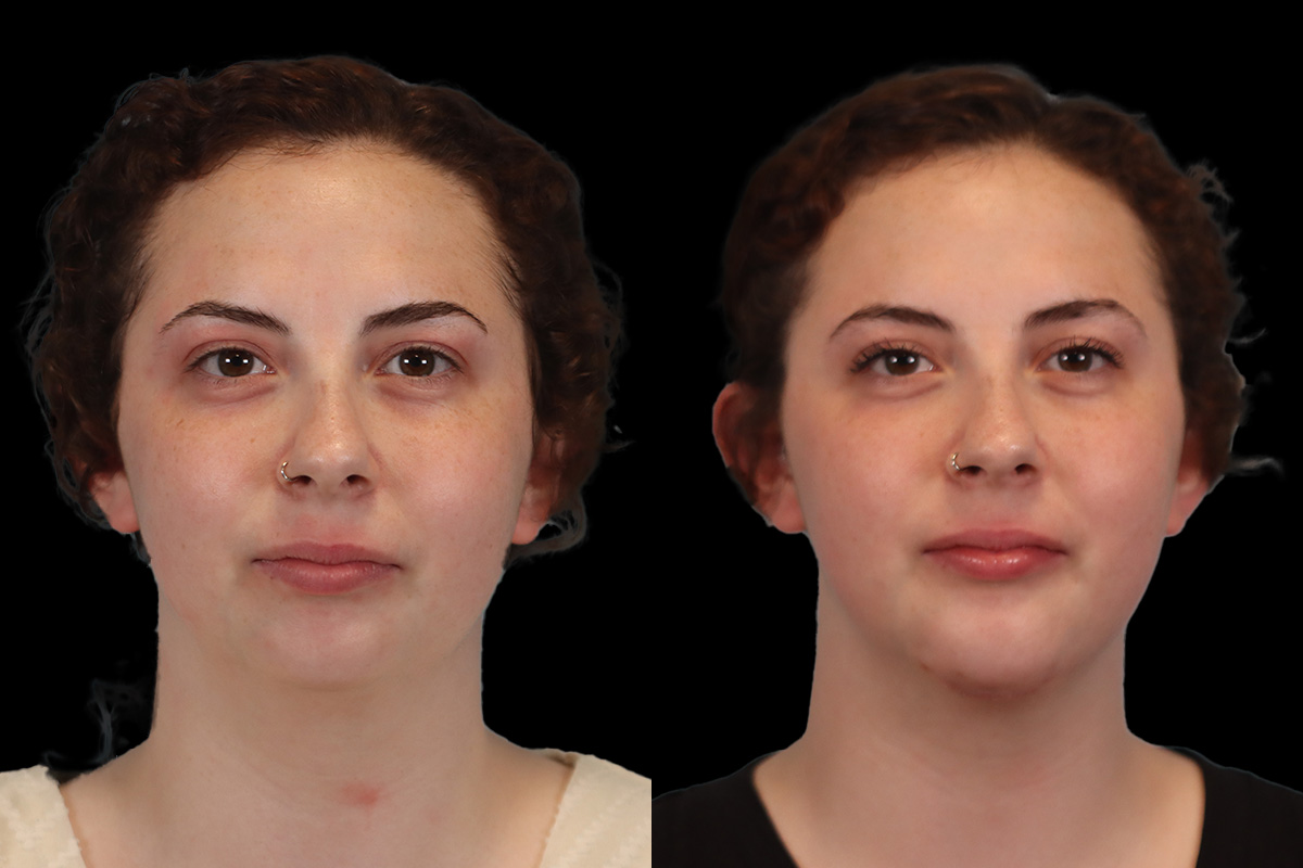 Chin Implant Before & After Gallery - Patient 775633 - Image 4