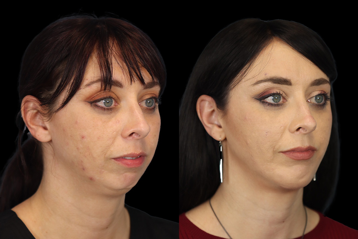 Chin Implant Before & After Gallery - Patient 258389 - Image 3