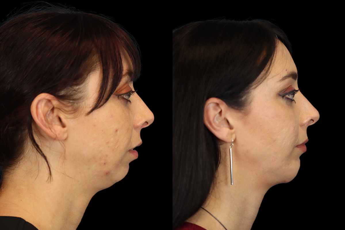 Chin Implant Before & After Gallery - Patient 258389 - Image 1