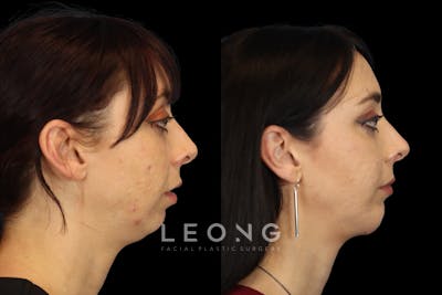Chin Jaw And Neck Before & After Gallery - Patient 407764 - Image 1