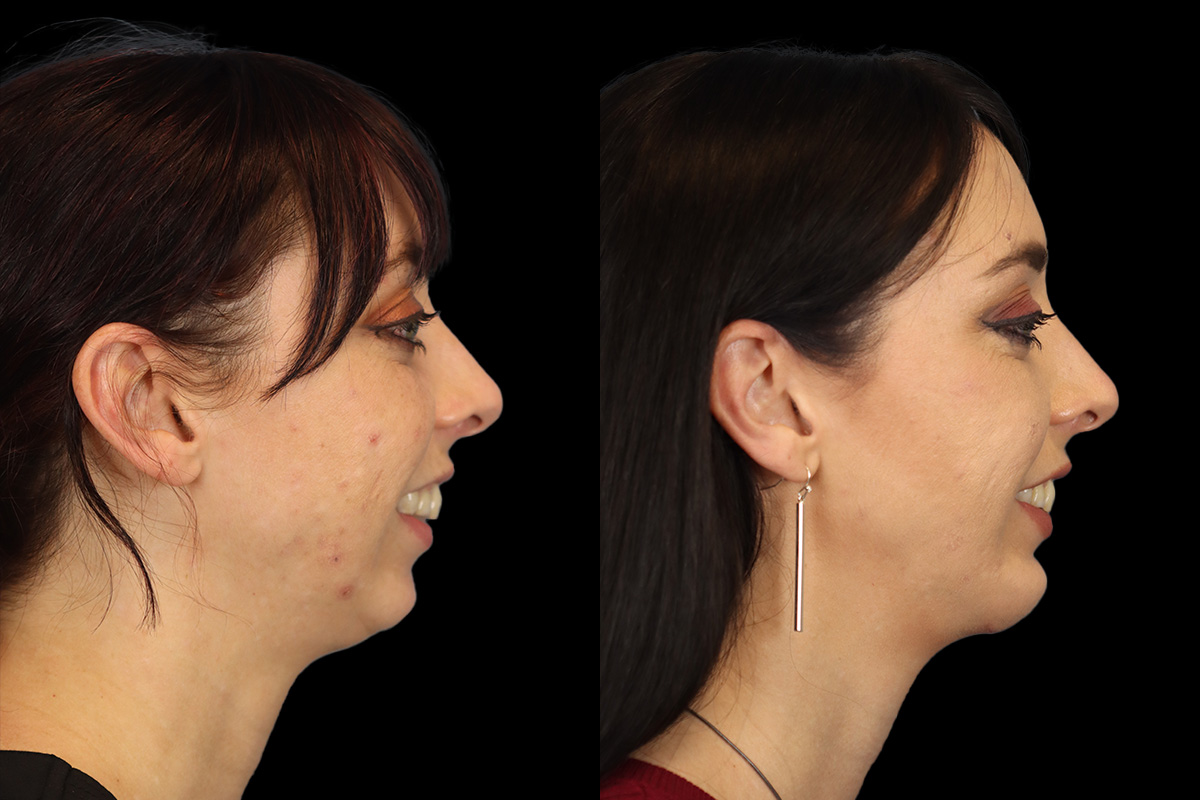 Chin Implant Before & After Gallery - Patient 258389 - Image 2