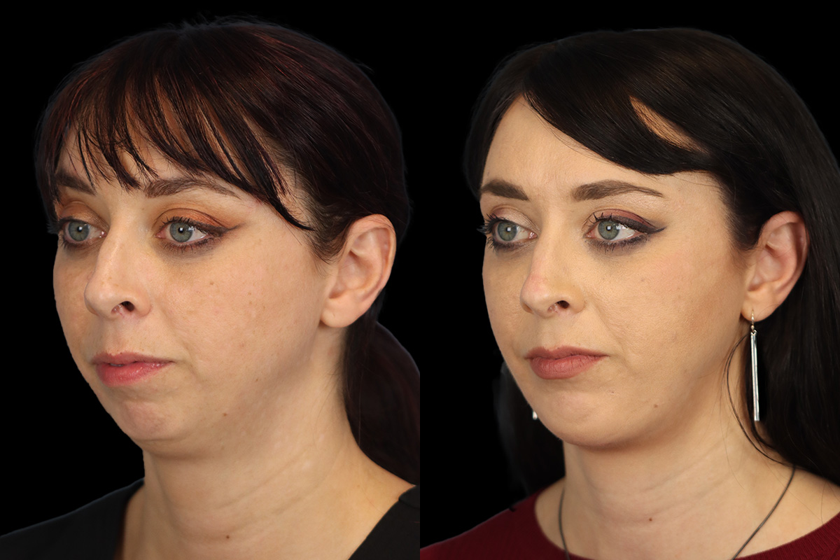 Chin Implant Before & After Gallery - Patient 258389 - Image 7