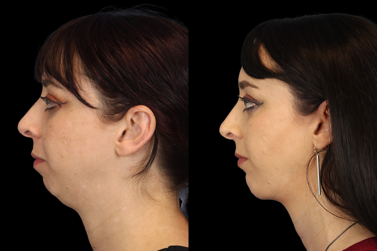 Chin Implant Before & After Gallery - Patient 258389 - Image 8