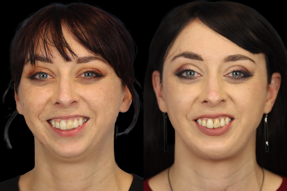 Chin Implant Before & After Gallery - Patient 258389 - Image 6