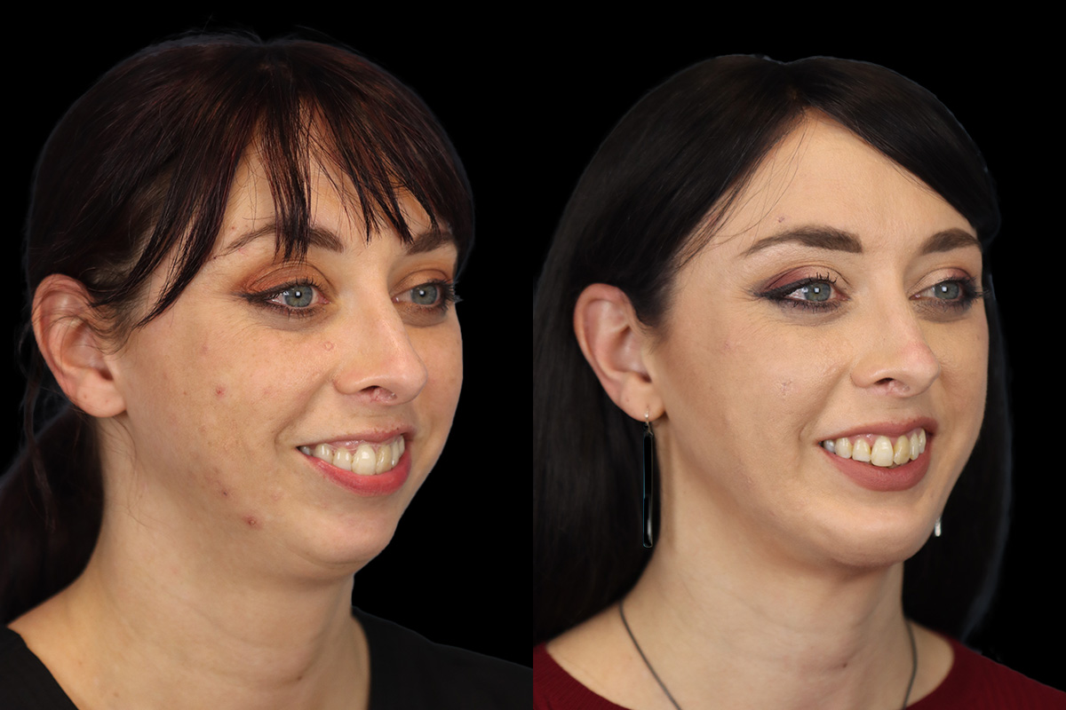 Chin Implant Before & After Gallery - Patient 258389 - Image 4