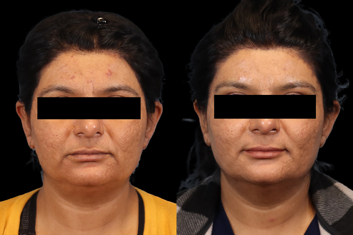 Brow lift Before & After Gallery - Patient 201786 - Image 1