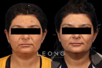 Brow lift Before & After Gallery - Patient 201786 - Image 1
