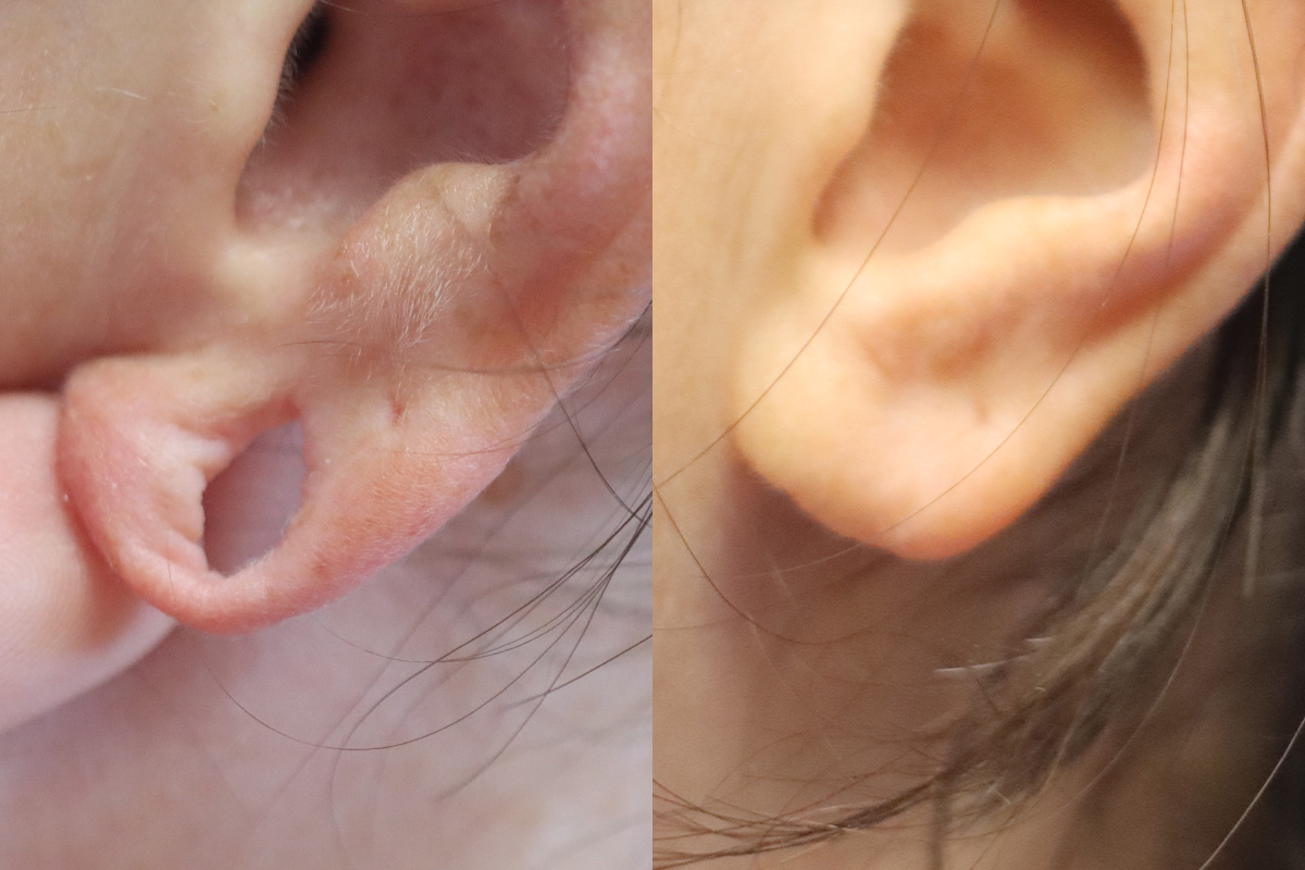 Earlobe Repair Before & After Gallery - Patient 477815 - Image 2
