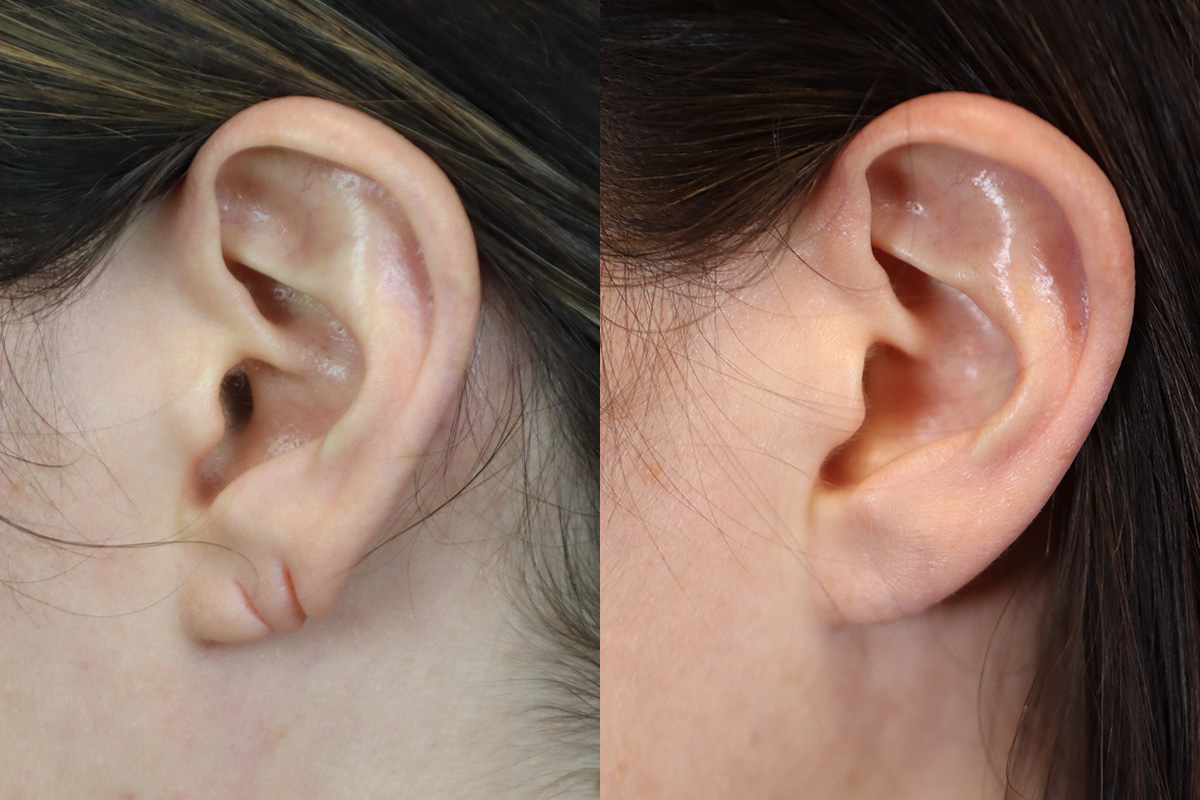 Earlobe Repair Before & After Gallery - Patient 340867 - Image 1