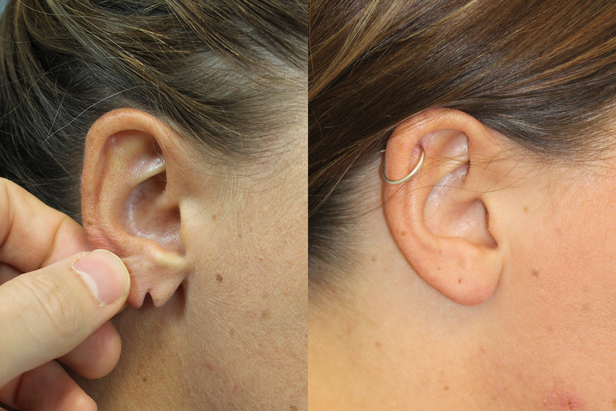 Earlobe Repair Before & After Gallery - Patient 317958 - Image 1