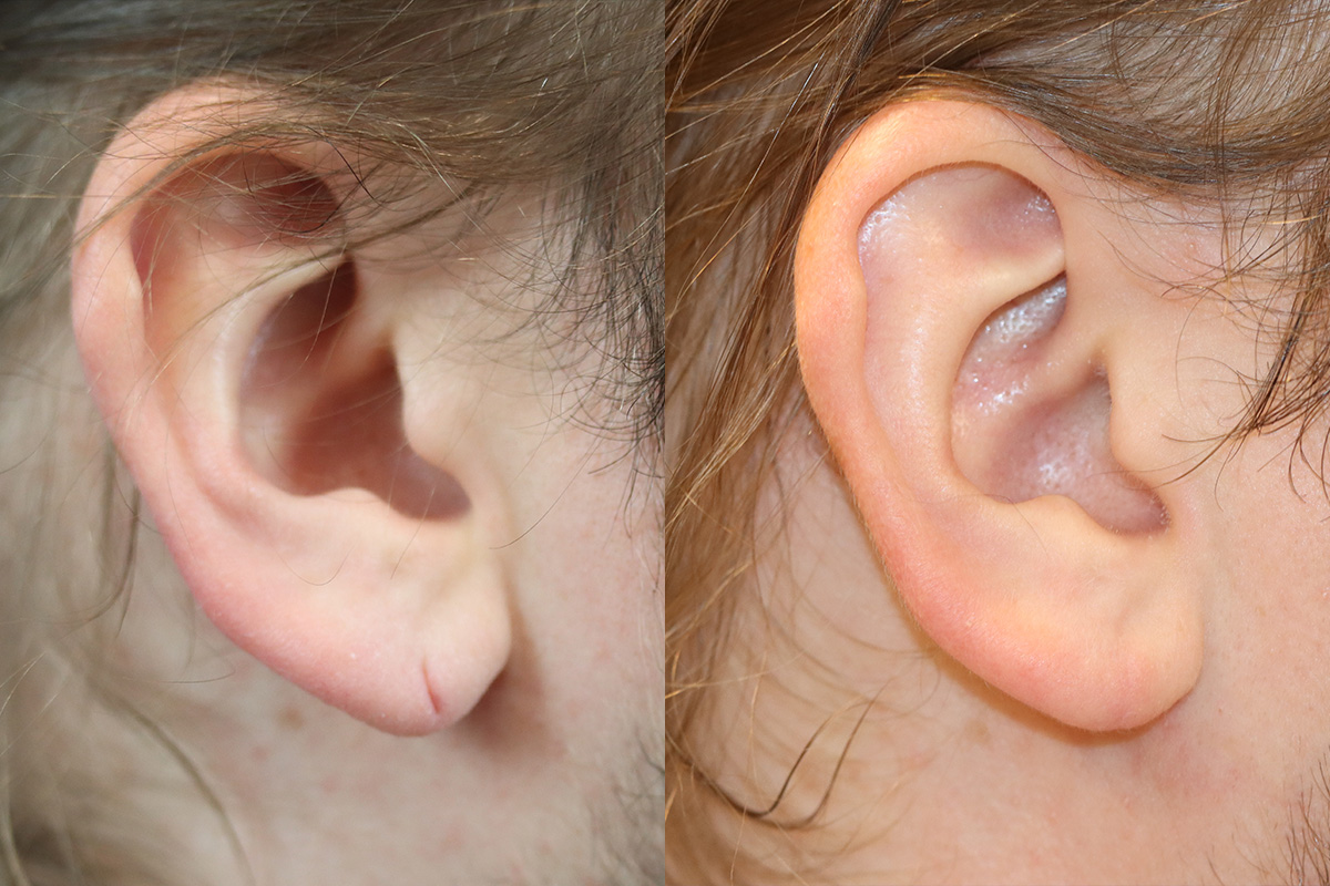 Earlobe Repair Before & After Gallery - Patient 107041 - Image 1