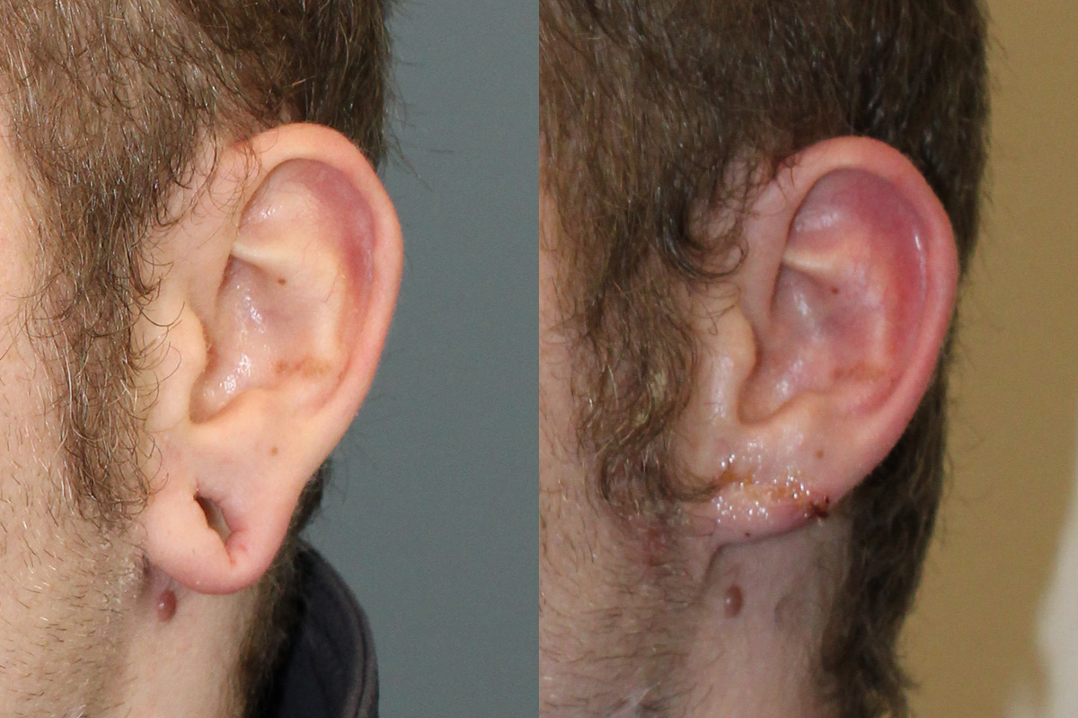 Earlobe Repair Before & After Gallery - Patient 247884 - Image 3