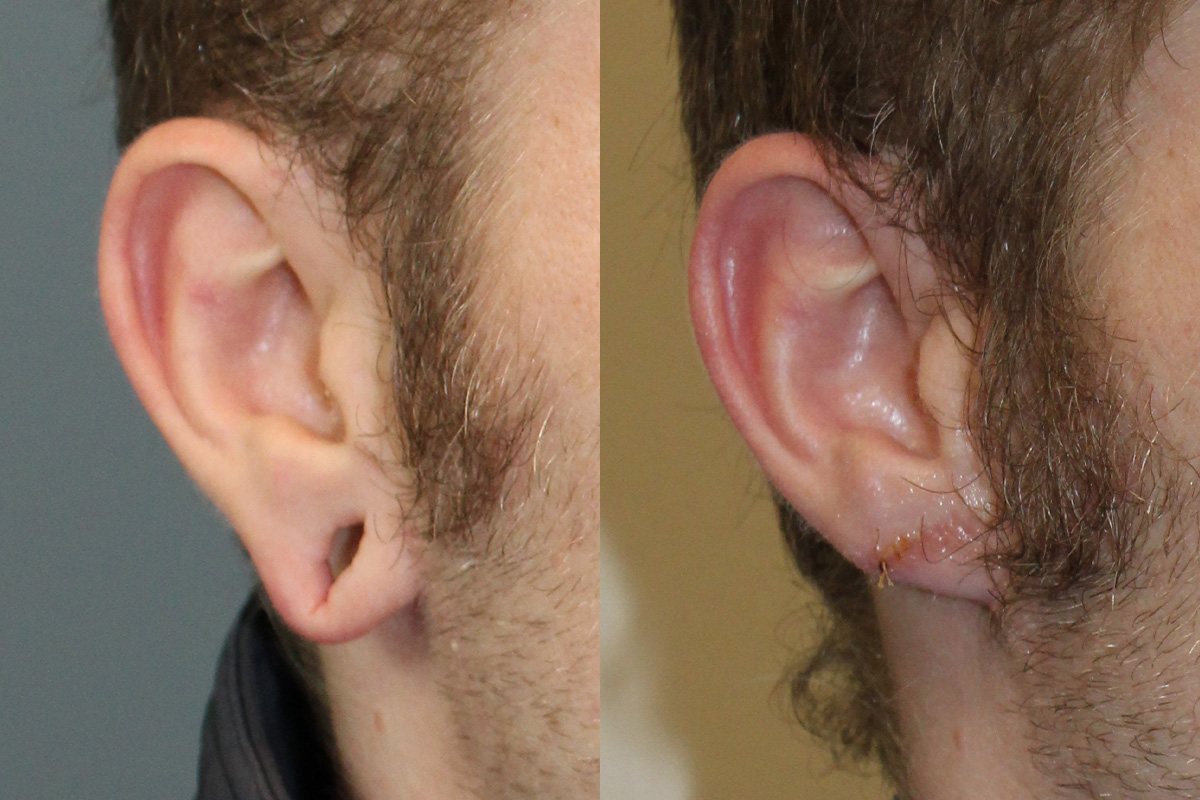 Earlobe Repair Before & After Gallery - Patient 247884 - Image 2