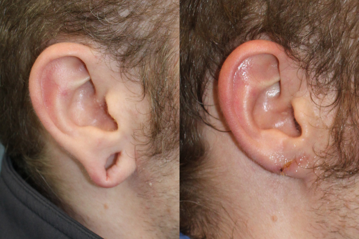 Earlobe Repair Before & After Gallery - Patient 247884 - Image 1